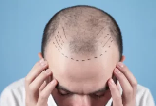 The Safety And Benefits Of FUE Hair Transplant For Men