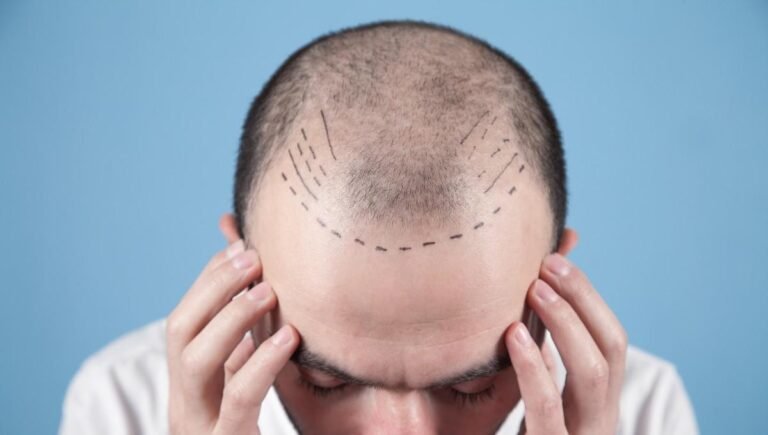 hair transplant for men